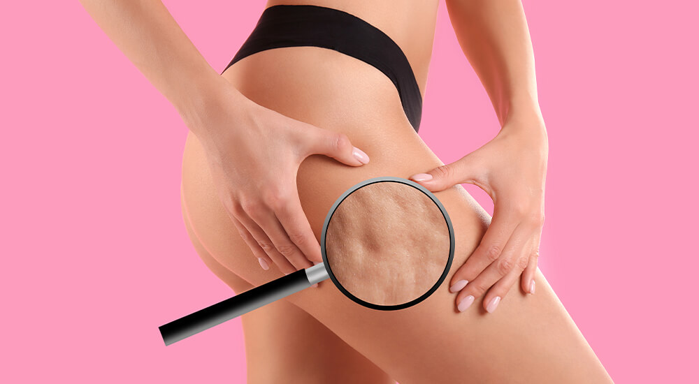 selulit-mezoterapisi